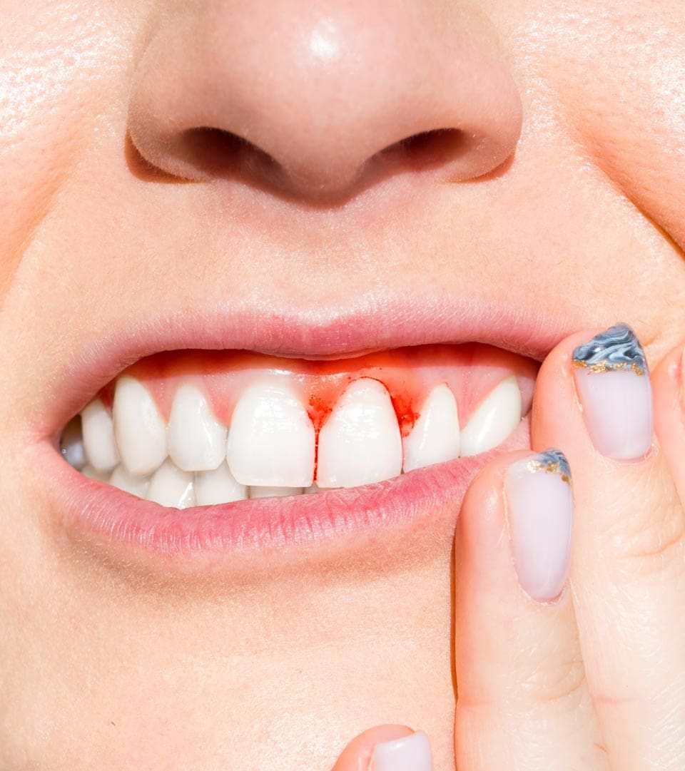 Geans Clinic - Periodontitis