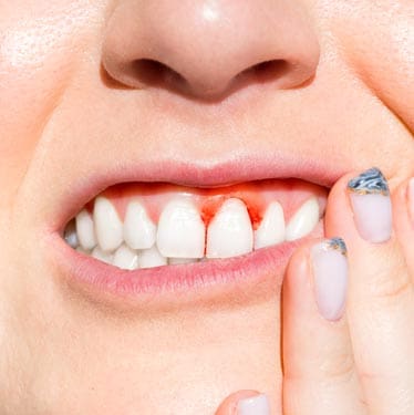 Geans Clinic - Periodontitis