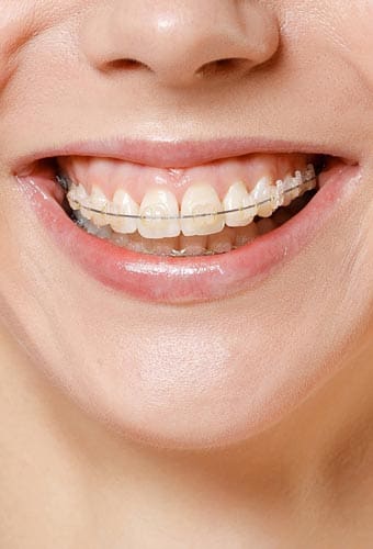 Geans Clinic - About Adult Braces