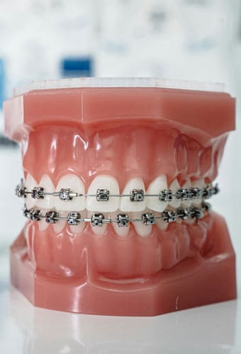 Geans Clinic - About Adult Braces