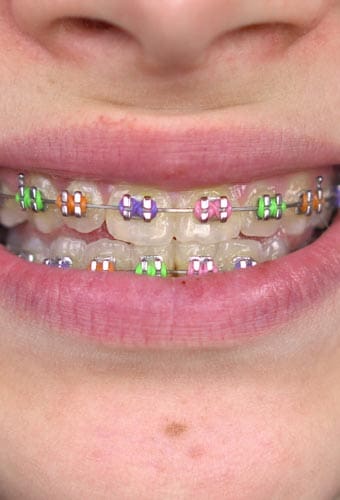 Geans Clinic - About Child and Teen Braces