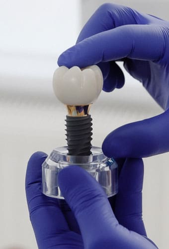 Geans Clinic - About Dental Implants