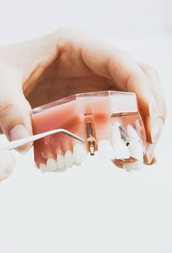 Geans Clinic - About Implant Maintenance