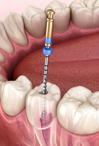 Geans Clinic - About Root Canal Treatment