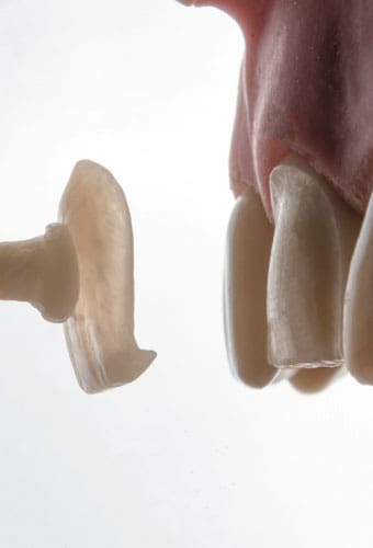 Geans Clinic - About Veneers