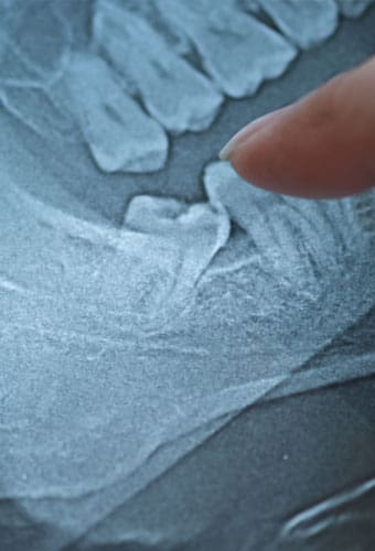 Geans Clinic - About Wisdom Tooth Extraction