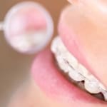 Geans Clinic - Adult Braces