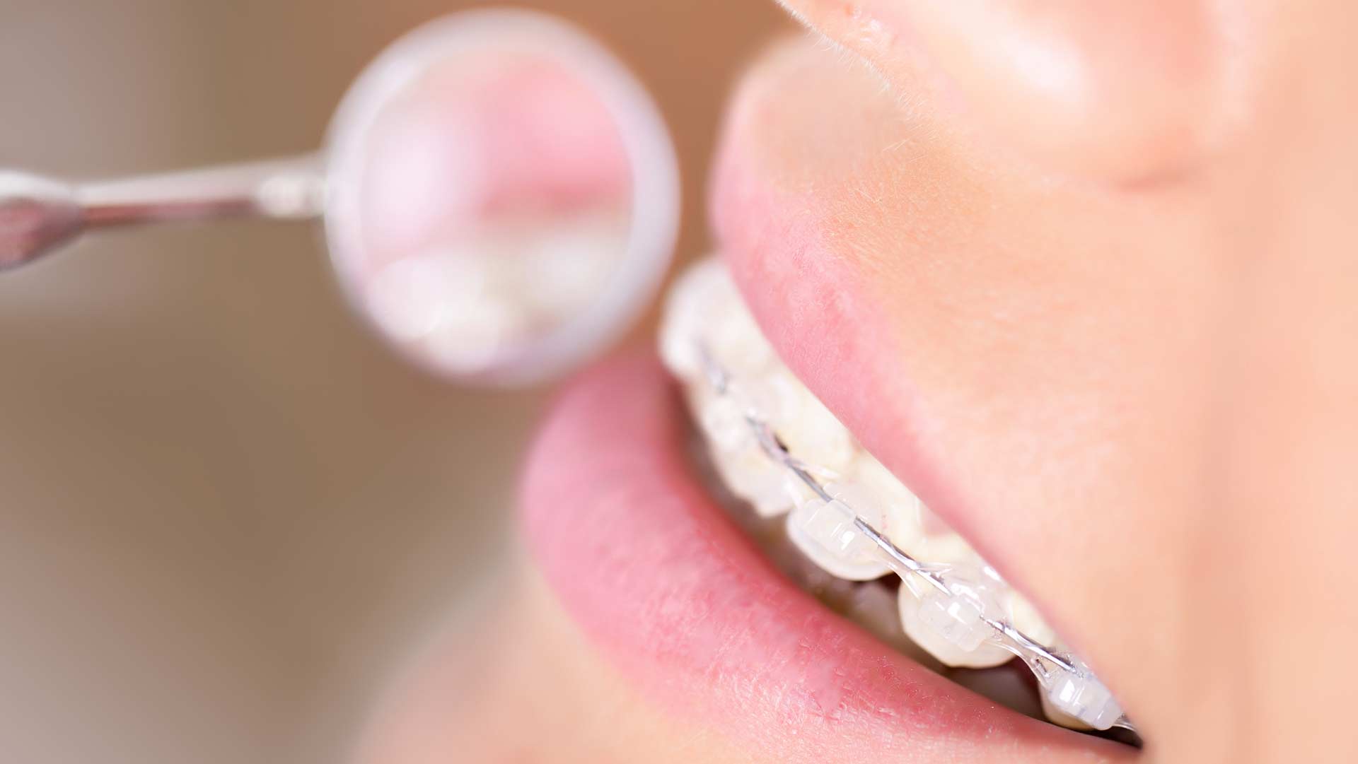 Geans Clinic - Adult Braces