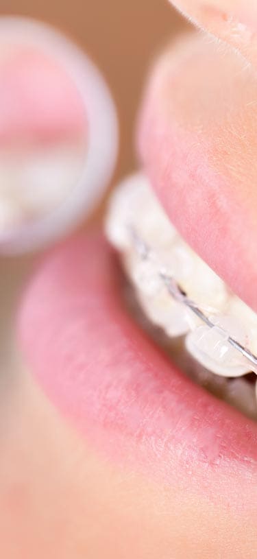 Geans Clinic - Adult Braces