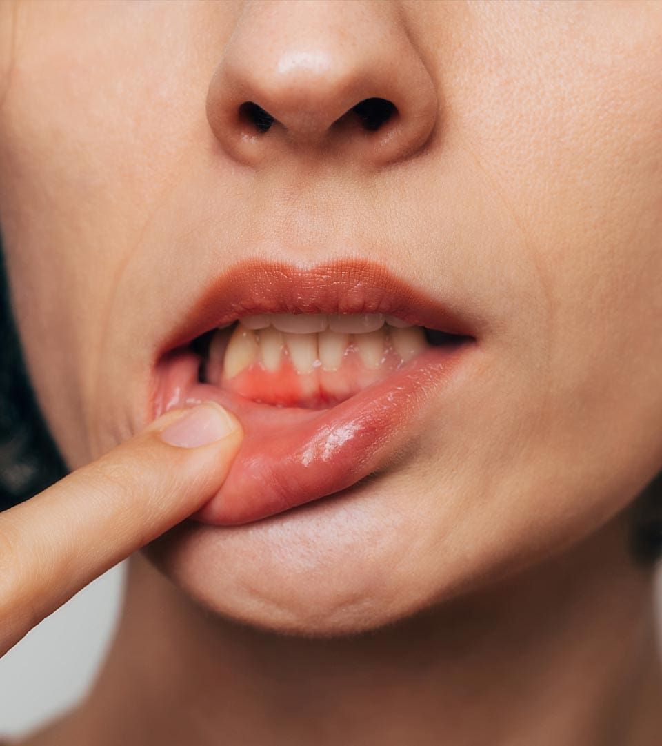 Geans Clinic - Bleeding Gums