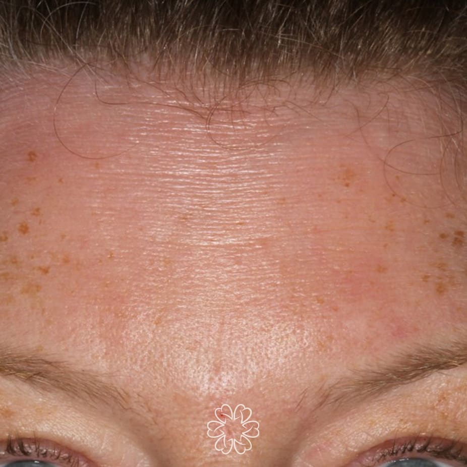 Geans Clinic - Botox Forehead Patient After