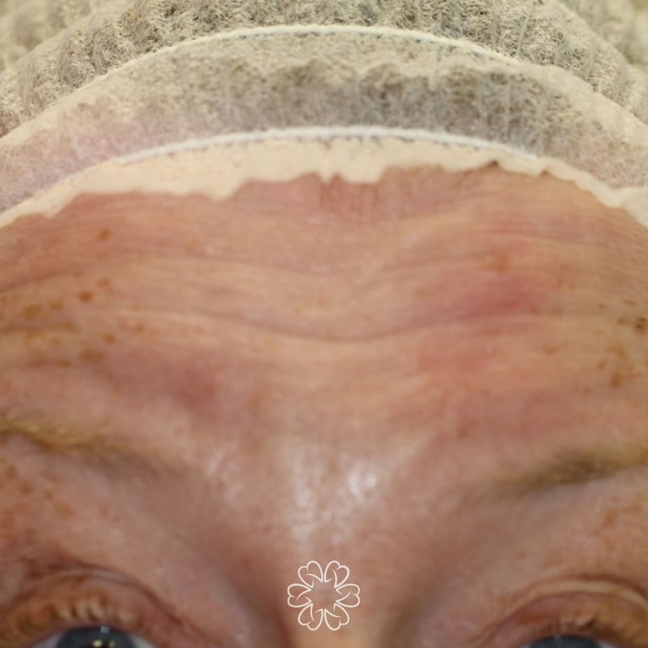 Geans Clinic - Botox Forehead Patient Before