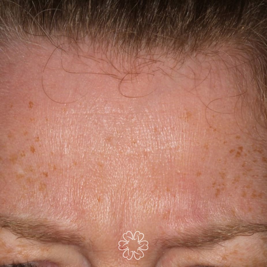 Geans Clinic - Botox Frown Patient After
