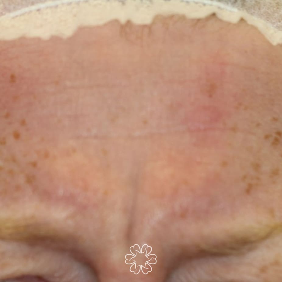 Geans Clinic - Botox Frown Patient Before