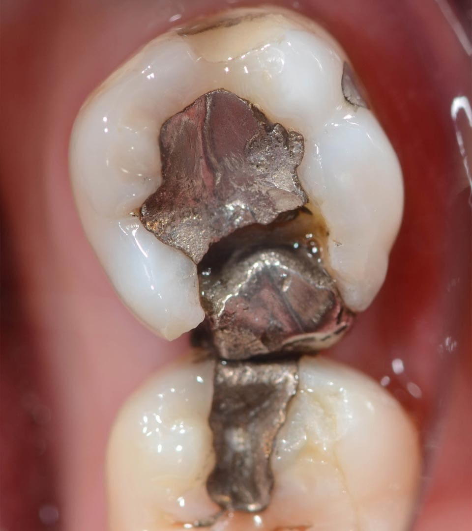 Geans Clinic - Broken Fillings