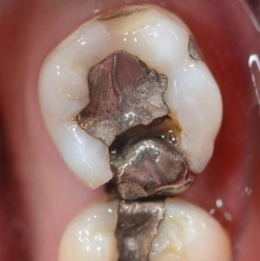 Geans Clinic - Broken Fillings