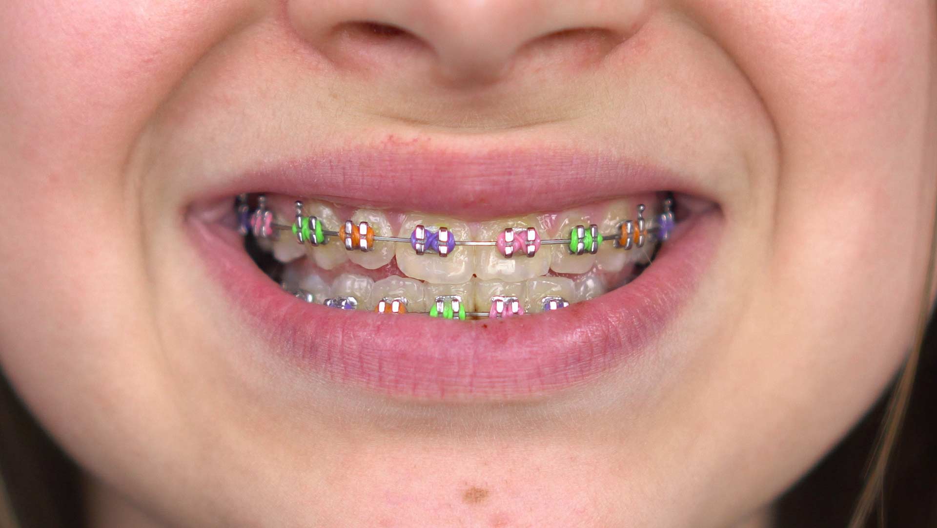 Geans Clinic - Child and Teen Braces