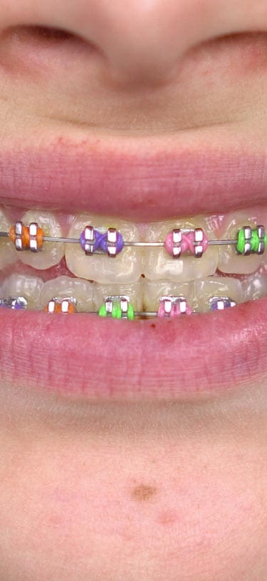 Geans Clinic - Child and Teen Braces