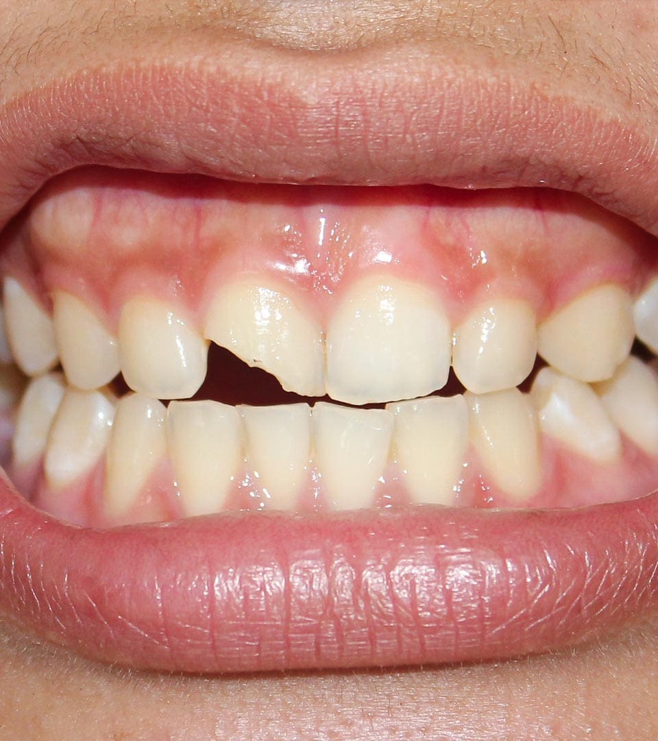 Geans Clinic - Chipped Teeth