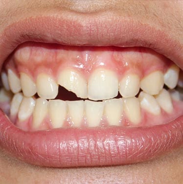 Geans Clinic - Chipped Teeth