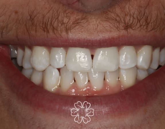 Geans Clinic - Composite Bonding Patient After