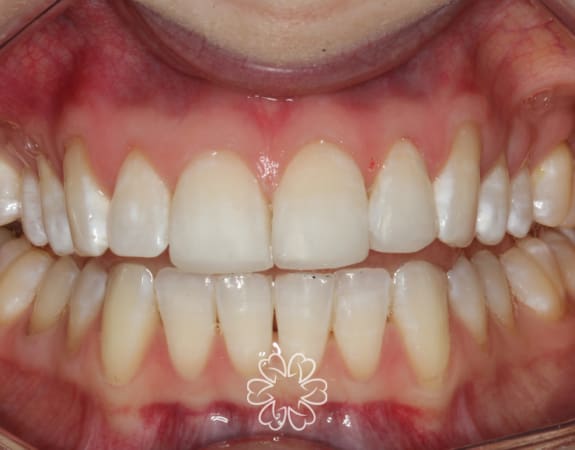Geans Clinic - Composite Bonding Patient After