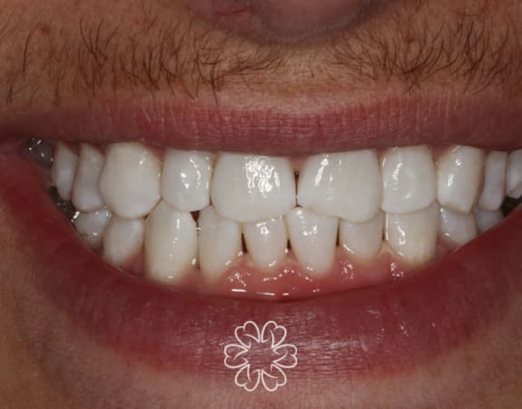 Geans Clinic - Composite Bonding Patient Before