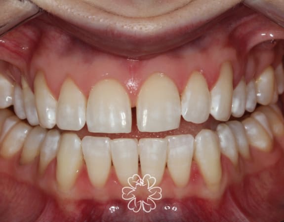 Geans Clinic - Composite Bonding Patient Before