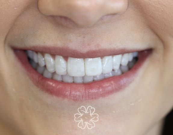 Geans Clinic - Cosmetic Bonding Patient After