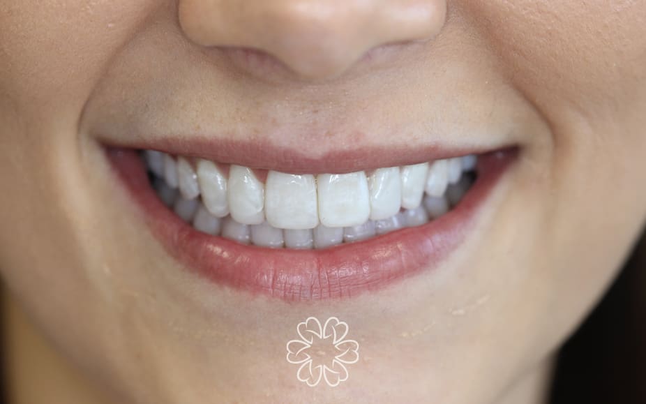 Geans Clinic - Cosmetic Bonding Patient After