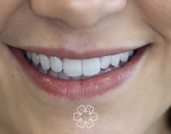 Geans Clinic - Cosmetic Bonding Patient Before