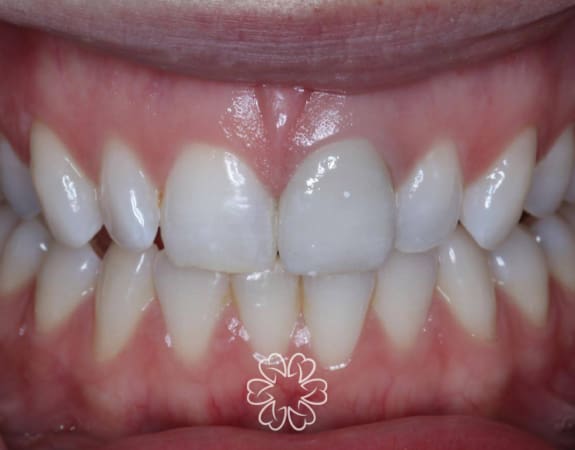 Geans Clinic - Crowns Patient After