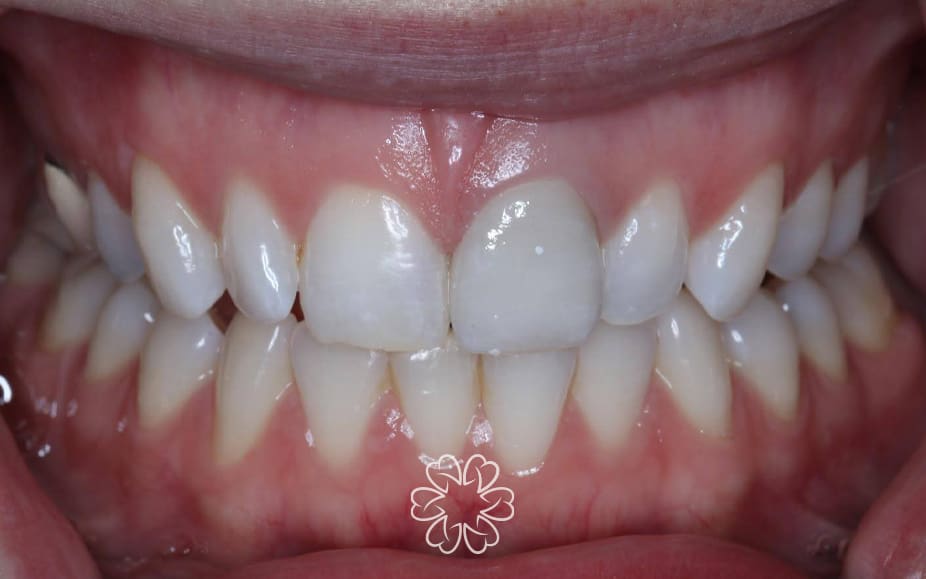 Geans Clinic - Crowns Patient After