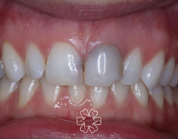Geans Clinic - Crowns Patient Before