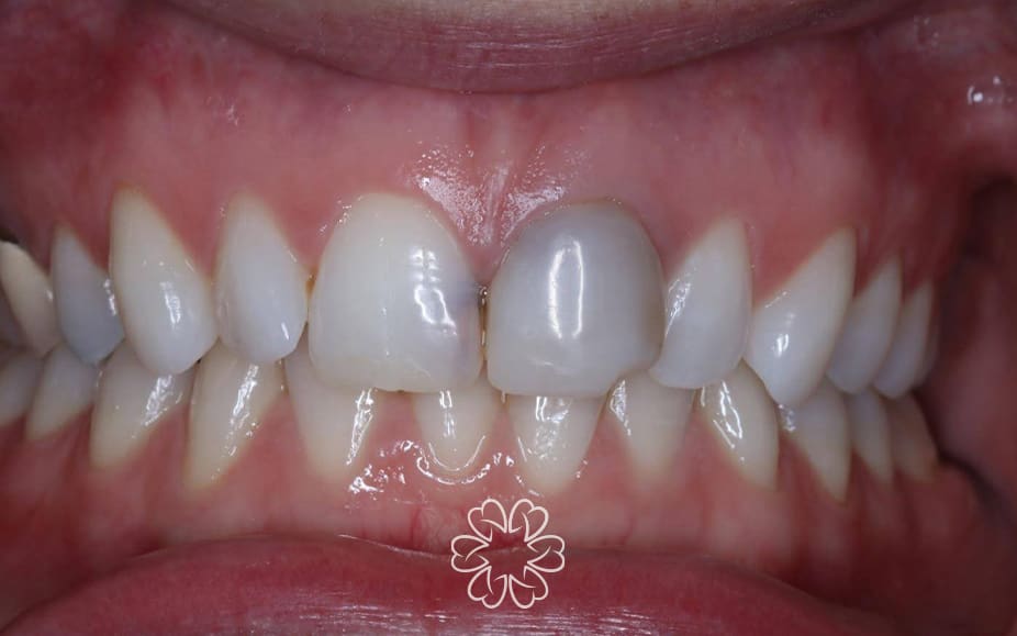 Geans Clinic - Crowns Patient Before