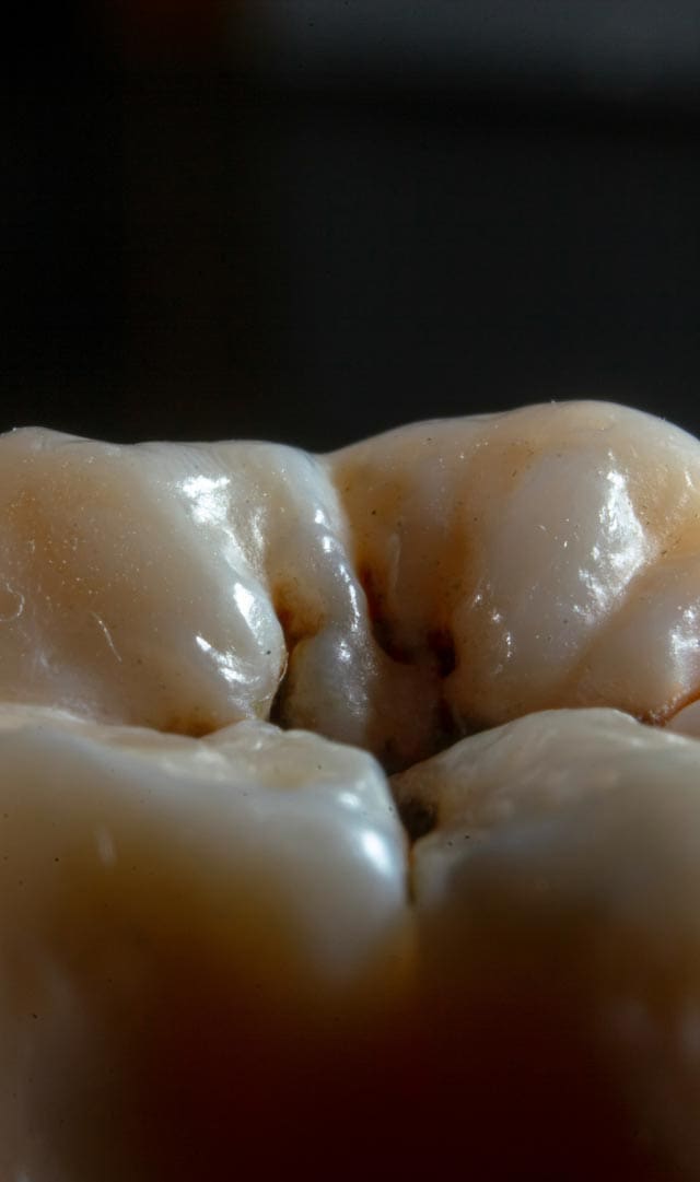 Geans Clinic - Dental Cavities Concern Details
