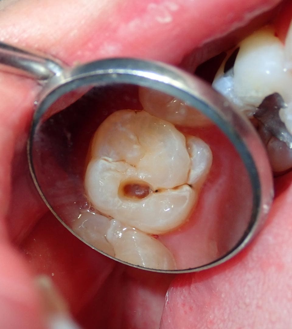 Geans Clinic - Dental Cavities