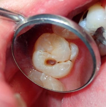 Geans Clinic - Dental Cavities