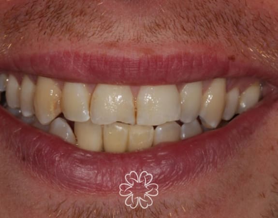 Geans Clinic - Dental Implants Patient After