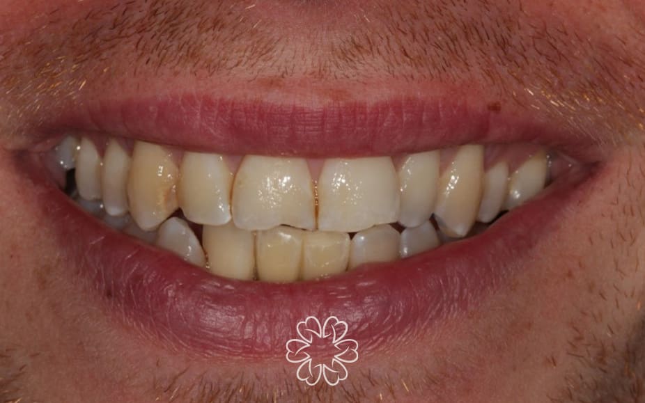 Geans Clinic - Dental Implants Patient After
