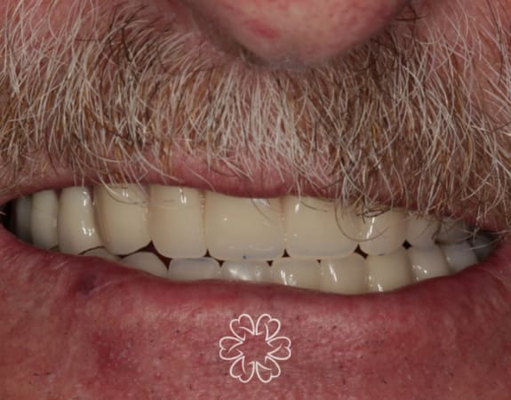 Geans Clinic - Dental Implants Patient After