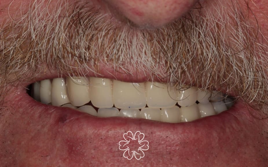 Geans Clinic - Dental Implants Patient After