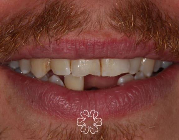 Geans Clinic - Dental Implants Patient Before