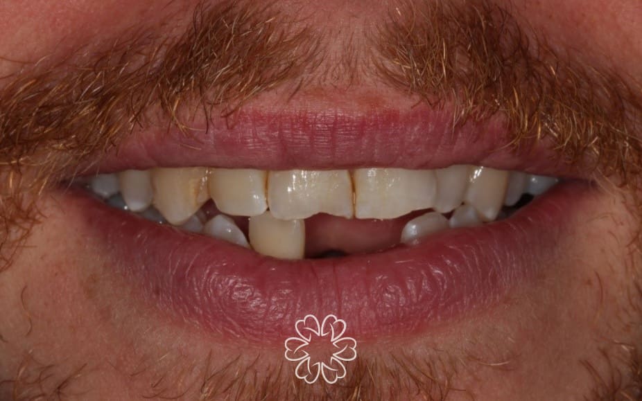 Geans Clinic - Dental Implants Patient Before