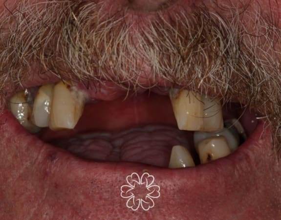Geans Clinic - Dental Implants Patient Before