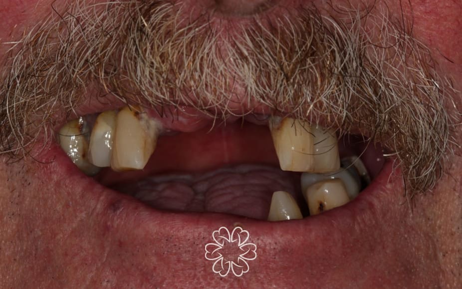 Geans Clinic - Dental Implants Patient Before
