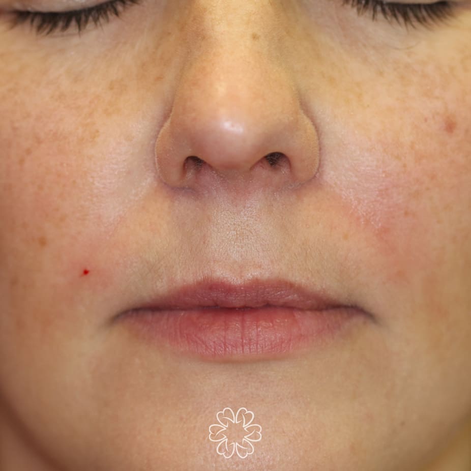Geans Clinic - Dermal Fillers Patient After