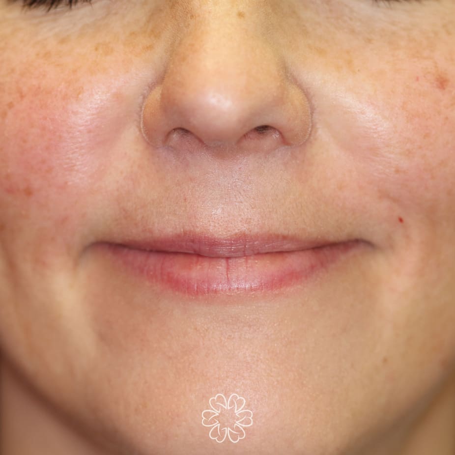 Geans Clinic - Dermal Fillers Patient After