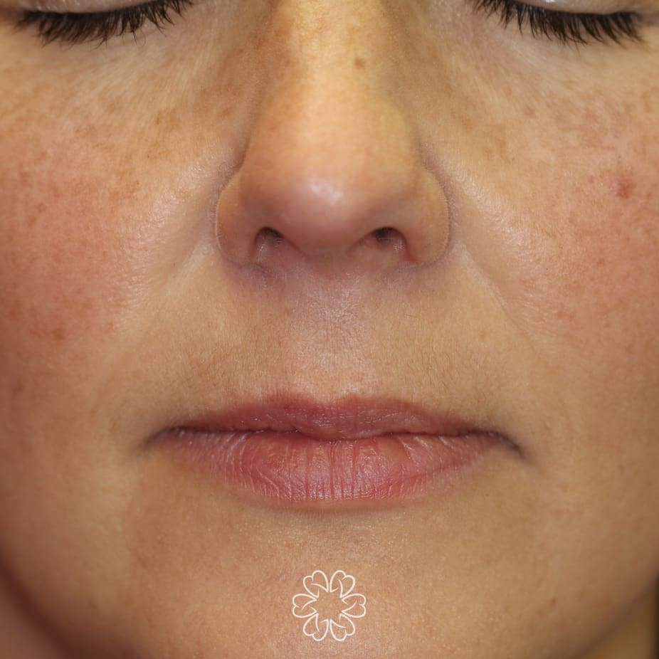 Geans Clinic - Dermal Fillers Patient Before