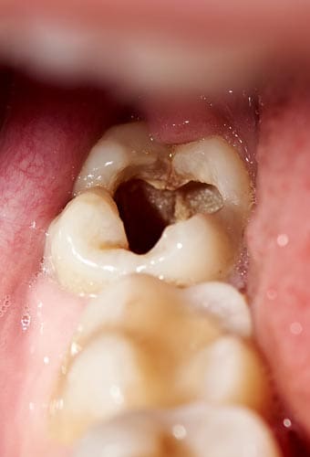Geans Clinic - Fillings About